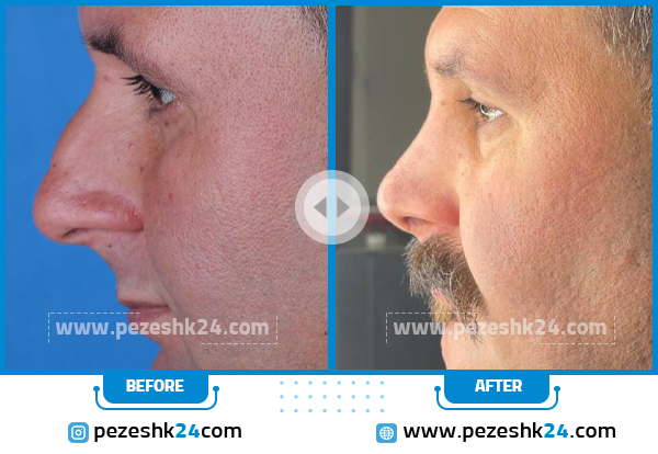 قبل و بعد عمل بینی مردانه دکتر رحیمی پور در تهران