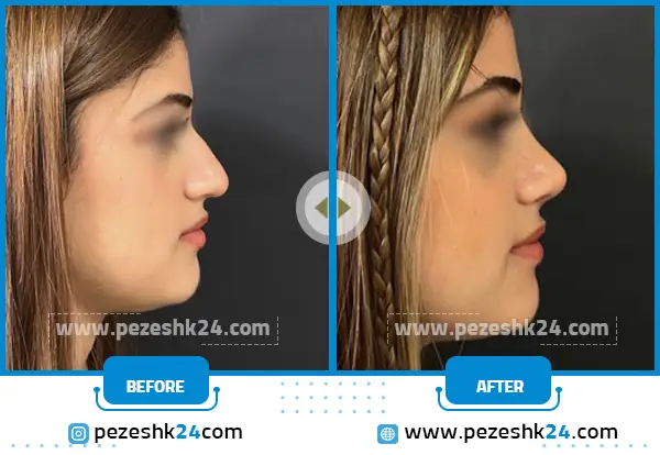 قبل و بعد جراحی بینی در تهران