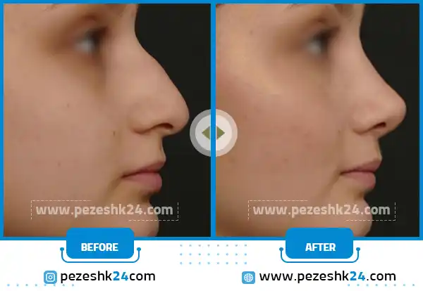 قبل و بعد بینی ترمیمی گوشتی تهران