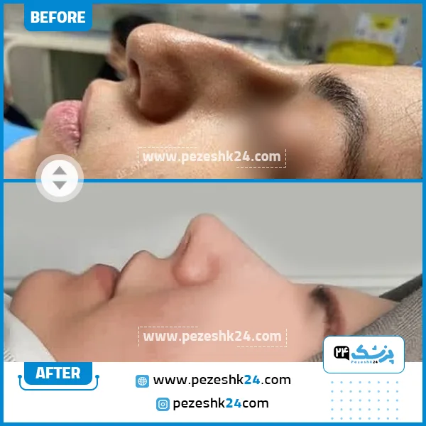 قبل و بعد عمل بینی دکتر نرگس عسگری