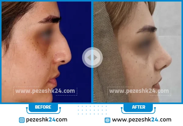 قبل و بعد عمل بینی دکتر عسگری اصفهان