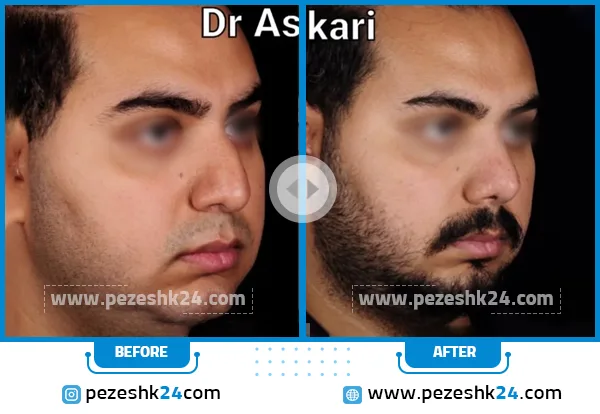 قبل و بعد عمل بینی دکتر عسگری