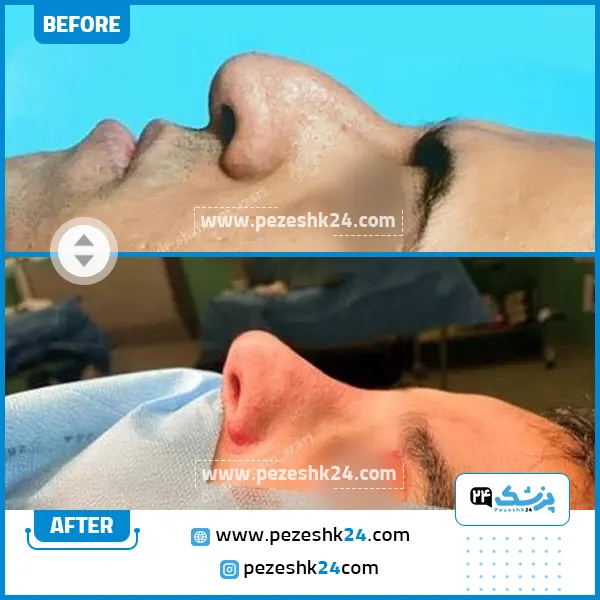 قبل و بعد عمل بینی دکتر آذری اصفهان