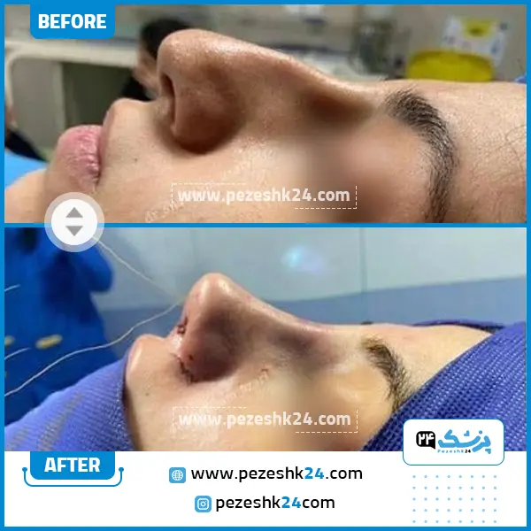 قبل و بعد عمل بینی دکتر شبنم آذری