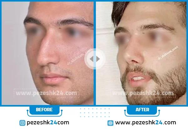قبل و بعد عمل بینی دکتر شبنم آذری اصفهان