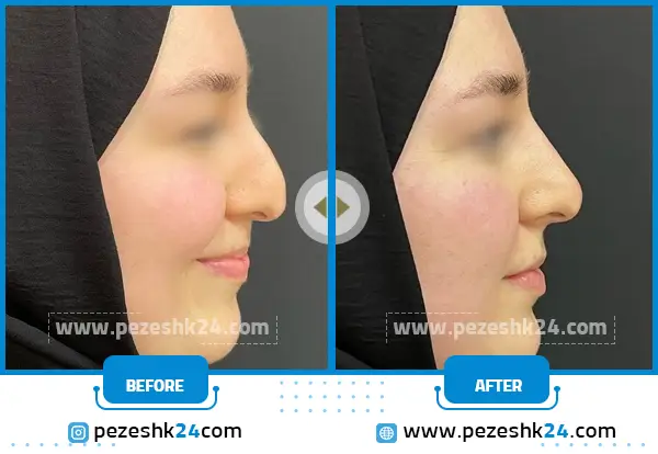 عمل ترمیم بینی بعد از چند ماه