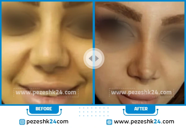 قبل و بعد عمل ترمیم بینی دکتر عباسی تهران