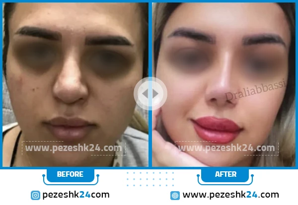 قبل و بعد عمل ترمیم بینی دکتر عباسی