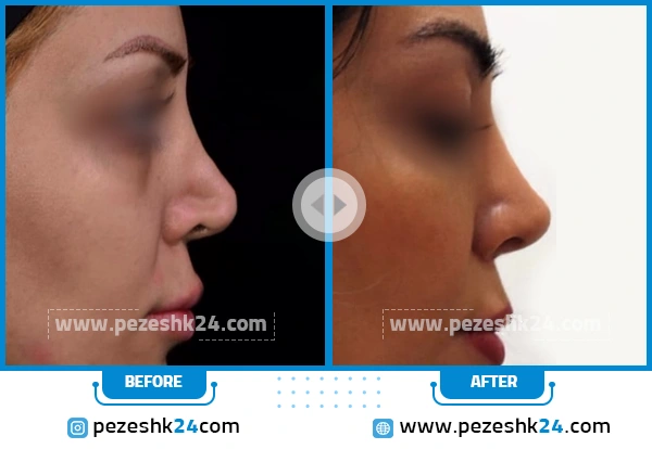 قبل و بعد جراحی بینی ترمیمی دکتر مقدم