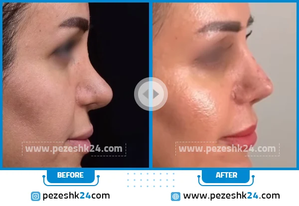 قبل و بعد عمل بینی دکتر دوغائی مقدم