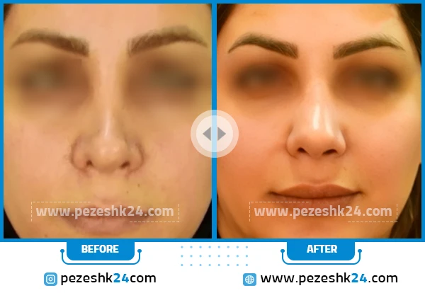 قبل و بعد عمل ترمیم بینی دکتر فتح سامی
