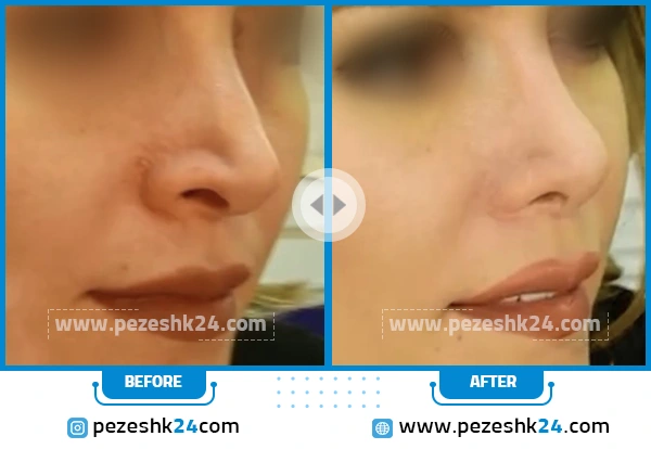 قبل و بعد عمل ترمیم بینی دکتر فتح سامی تهران