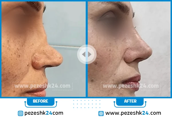 قبل و بعد عمل ترمیم بینی دکتر مهربانی