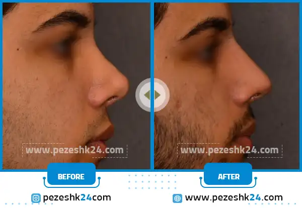 باریک شدن تیغه بینی بعد جراحی 