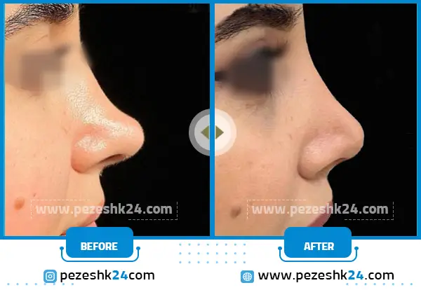 قبل و بعد از جراحی ترمیمی بینی