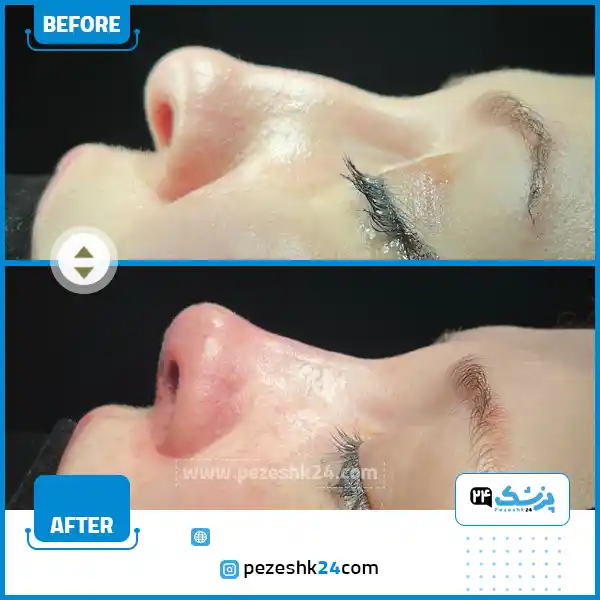قبل و بعد جراحی ترمیم بینی رشت