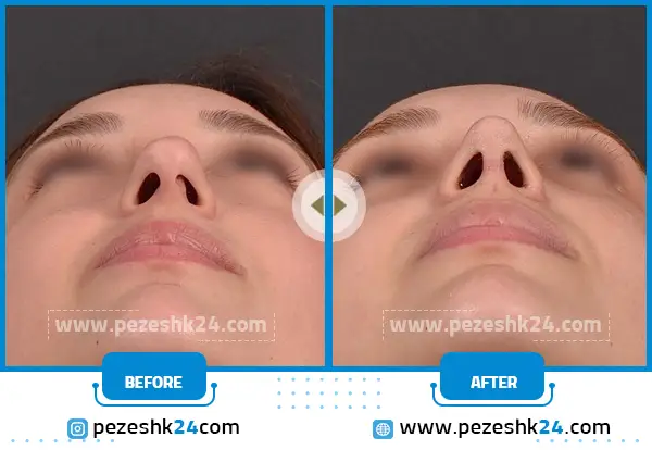 نوک غیر طبیعی بینی بعد جراحی