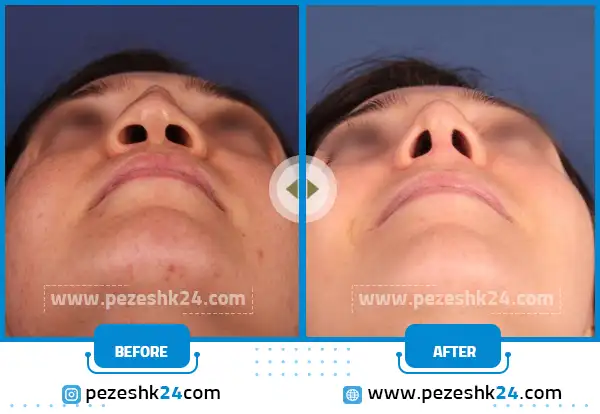 سوراخ های نامتقارن بینی بعد جراحی