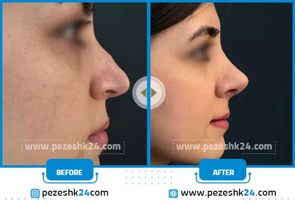 عمل پره های بینی با بی حسی