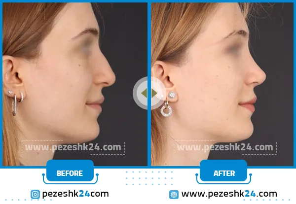 قبل و بعد جراحی ترمیم بینی رشت