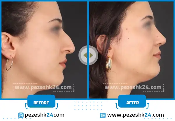 عکس های ترمیم بینی رشت