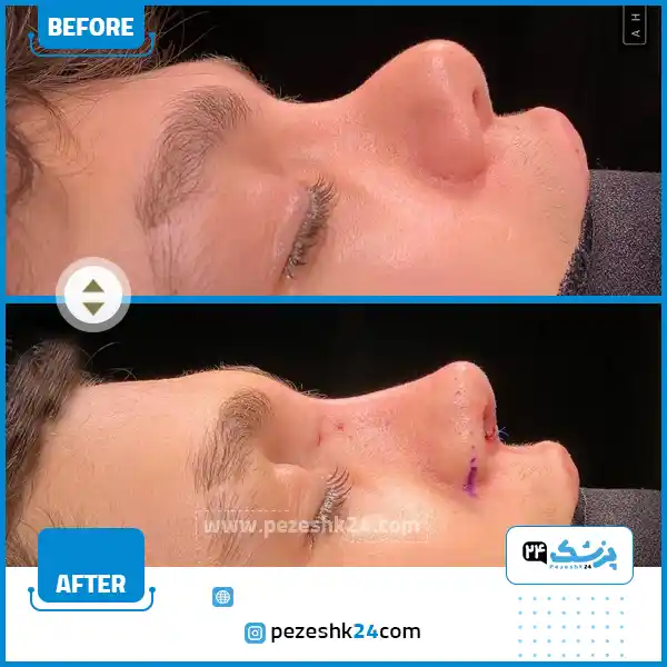 ترمیم نوک بینی عمل شده