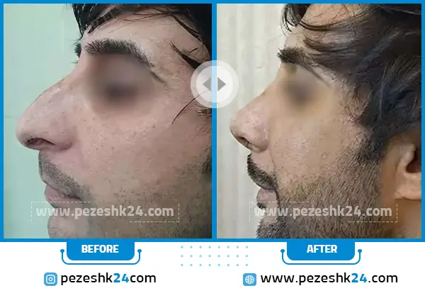 قبل و بعد عمل بینی دکتر آذرنوش