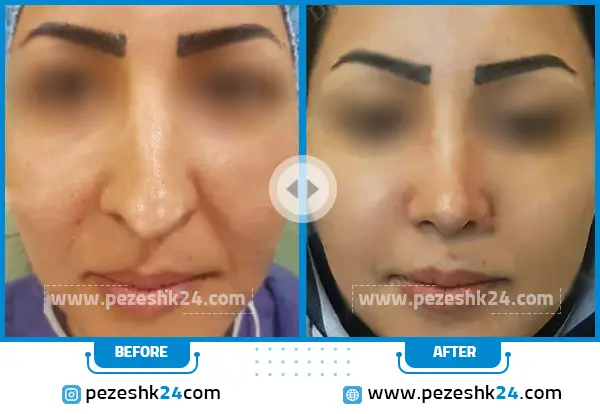 قبل و بعد از عمل بینی دکتر آذرنوش