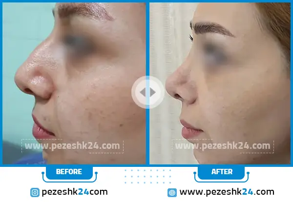 قبل و بعد عمل بینی دکتر آذرنوش مشهد
