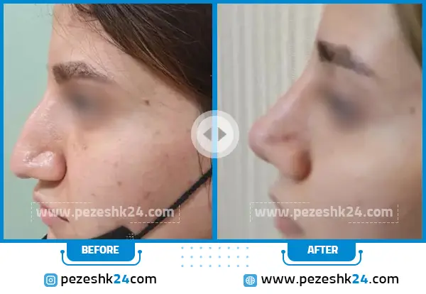 قبل و بعد جراحی بینی دکتر اذرنوش