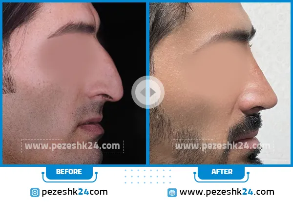 قبل و بعد عمل بینی دکتر کاظمی شیراز