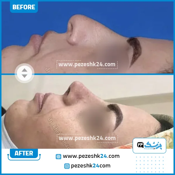قبل و بعد عمل بینی دکتر خرمند
