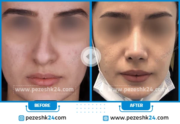 قبل و بعد عمل زیبایی بینی دکتر خرمند