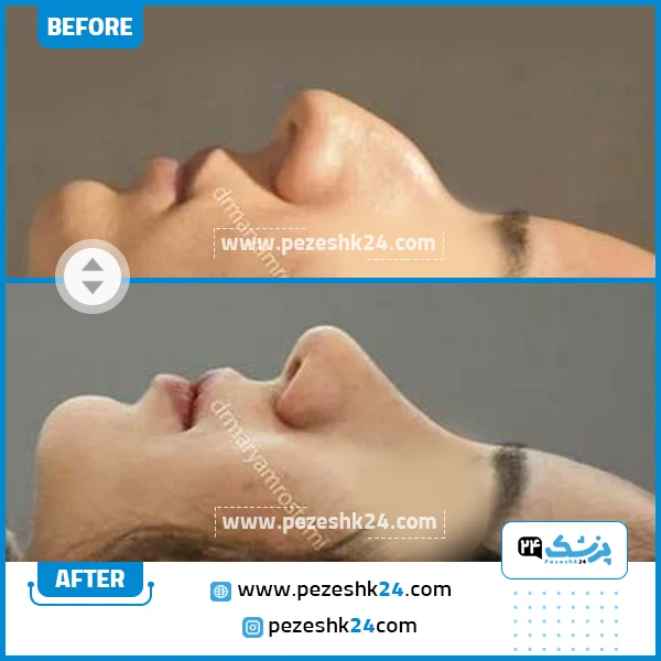 قبل و بعد عمل بینی دکتر رستمی اصفهان