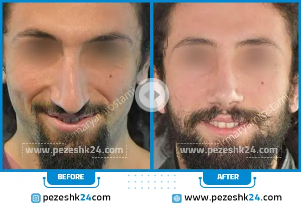 قبل و بعد عمل زیبایی بینی دکتر رستمی