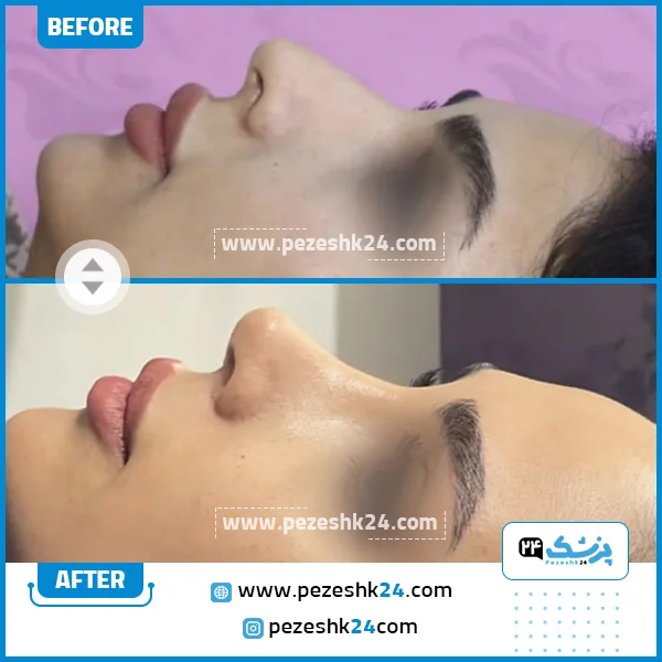 قبل و بعد عمل بینی دکتر صادقی