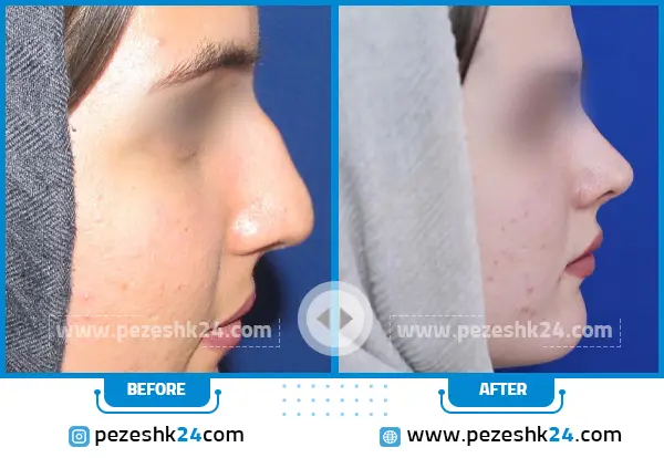 قبل و بعد عمل بینی دکتر هنرور