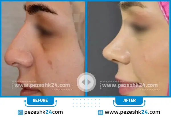 قبل و بعد عمل بینی دکتر هنرور مشهد