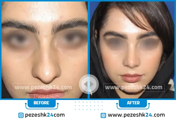 قبل و بعد عمل بینی دکتر حسن هنرور