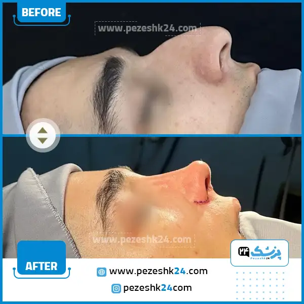 قبل و بعد جراحی بینی آقایان