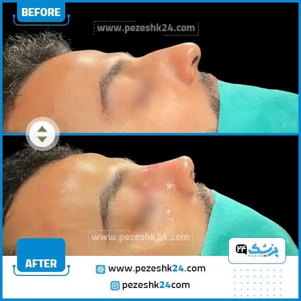 قبل و بعد عمل بینی فانتزی آقایان