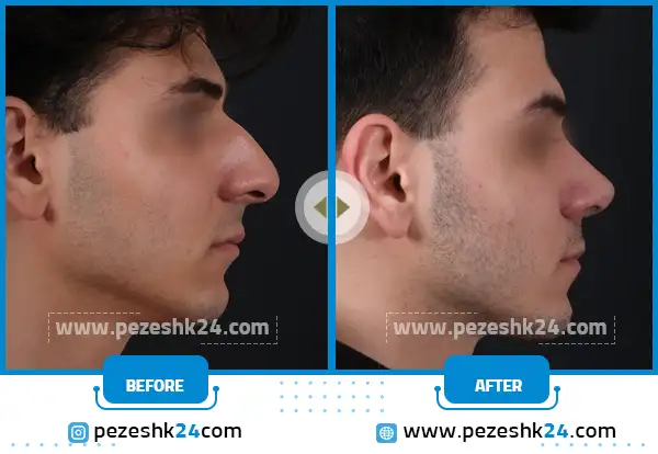 قبل و بعد عمل بینی نوک تیز مردانه