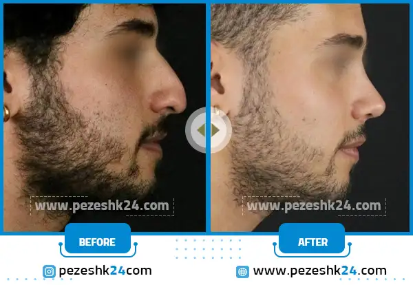 قبل و بعد عمل بینی طبیعی آقایان در مشهد