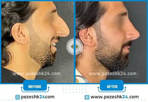 قبل و بعد بینی رومی مردانه