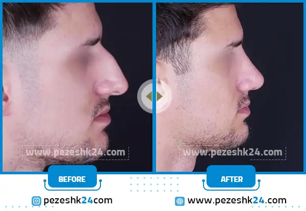 قبل و بعد عمل جراحی بینی مردانه