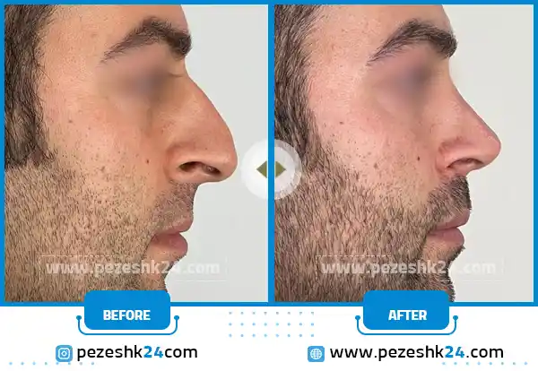 قبل و بعد عمل بینی مردانه در مشهد