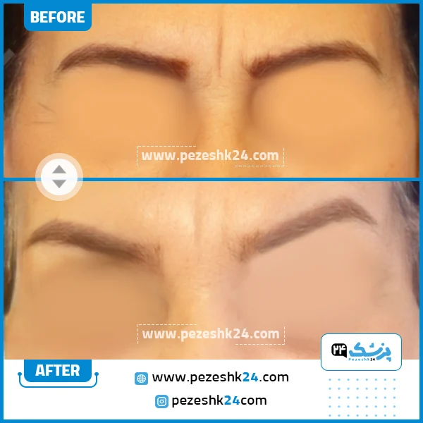 قبل و بعد لیفت شقیقه دکتر بهجو