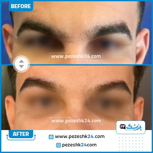 قبل و بعد لیفت شقیقه دکتر بهجو تهران