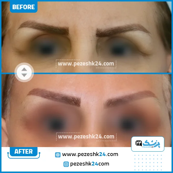 عکس قبل و بعد لیفت شقیقه دکتر بهجو