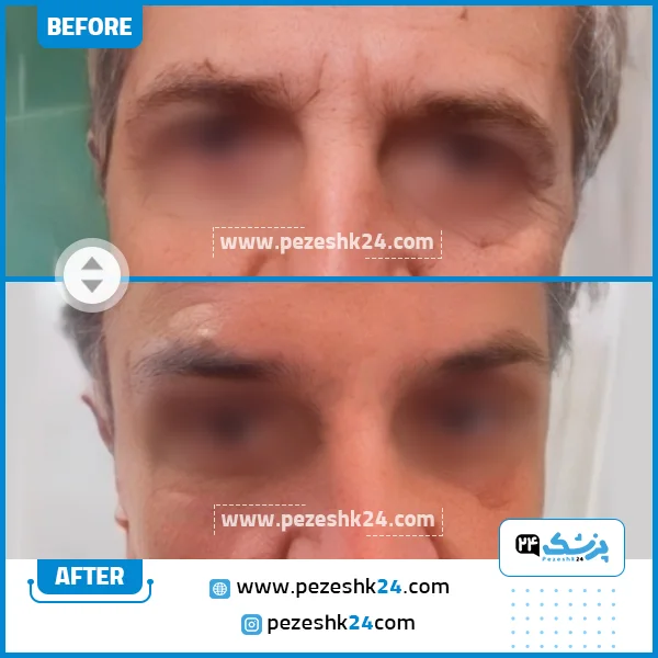 قبل و بعد لیفت شقیقه دکتر بهجو